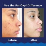 PanOxyl 10% Benzoyl Peroxide Acne Foaming Wash, Maximum Strength, Daily Acne-Fighting Face and Body Cleanser, Face Wash to Clear, Treat and Prevent Acne Pimples and Stubborn Breakouts, 5.5 Oz Tube - Image 4
